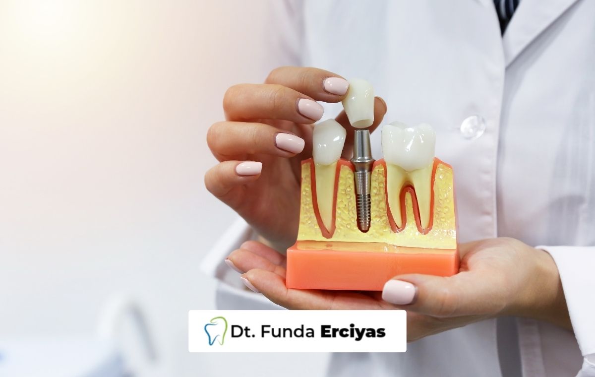 All-on-4 Implant
